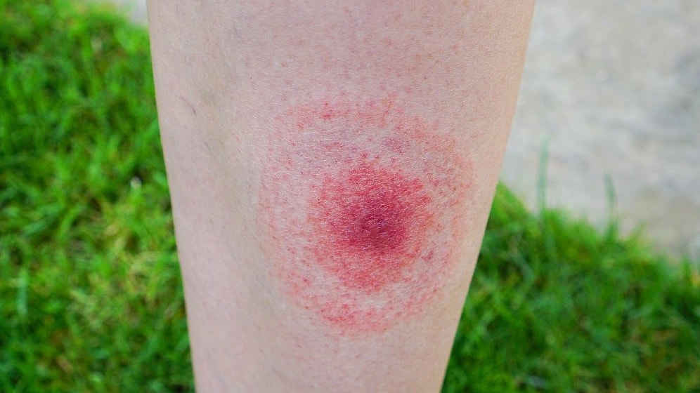 Lyme Hastalığı Bulaşıcı mıdır?