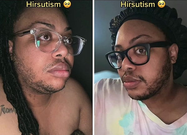 Нелли впервые поделилась историей о своем состоянии в видео на TikTok, и оно стало вирусным.