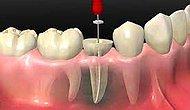 Endodonti Nedir? Hangi Hastalıklara Bakar?