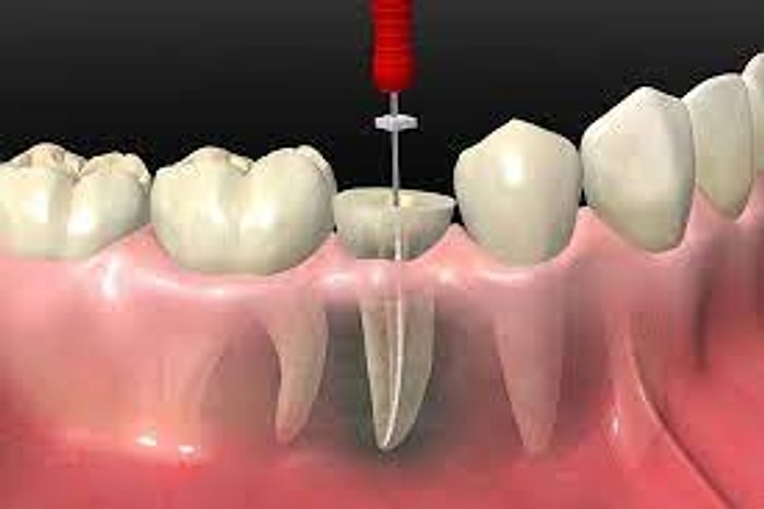 Endodonti Nedir? Hangi Hastalıklara Bakar?