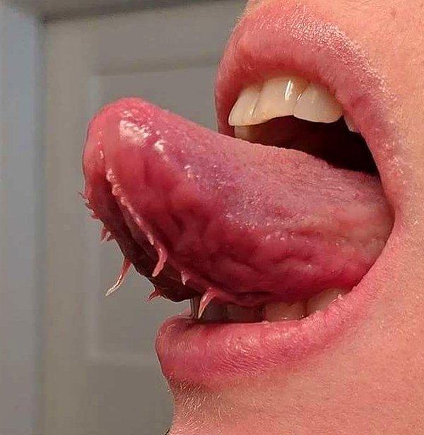 2. "Dilinin altındaki zarda enteresan kıvrımlara sahip olan bir hasta."