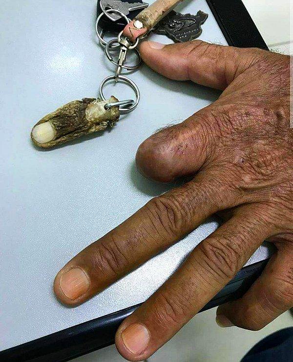 15. "Parmağı kopan bir adam ameliyattan sonra hatıra olarak saklamak istedi."