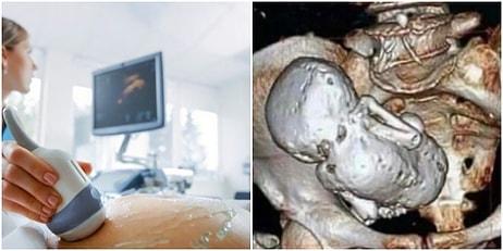 Korkunç Olay Dünya Gündeminde! Ultrason Görüntüsüne Bakan Doktor Bebeğin Haline İnanamadı