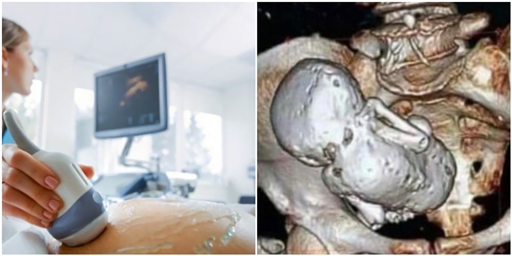 Korkunç Olay Dünya Gündeminde! Ultrason Görüntüsüne Bakan Doktor Bebeğin Haline İnanamadı