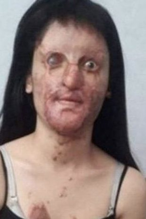 Берфин почти постоянно испытывает боли, и после нападения у нее осталось всего 30% зрения.