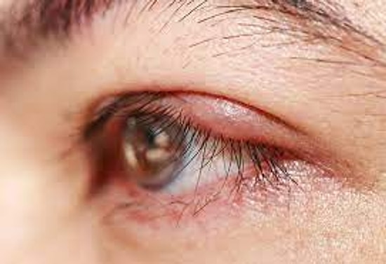 Kirpik İltihaplanmasına Hangi Bölüm/Doktor Bakar?