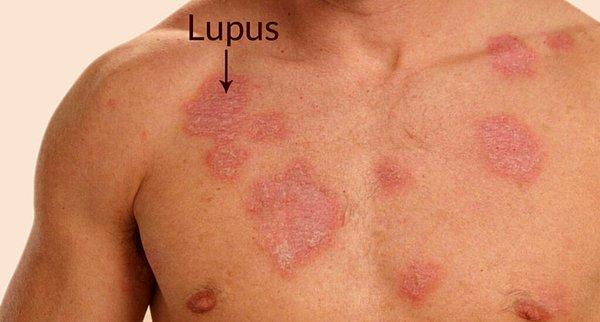 Kelebek Hastalığı (Lupus) Nedir?