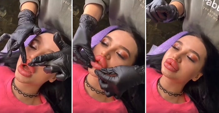Bu Normal mi? Dudak Estetiği Yaptıran Kadının Bi' Acayip Dolgunluktaki Dudaklarının Görüntüsü Viral Oldu!