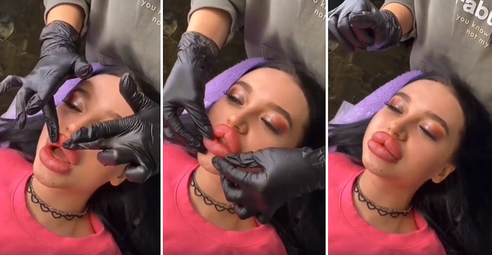 Bu Normal mi? Dudak Estetiği Yaptıran Kadının Bi' Acayip Dolgunluktaki Dudaklarının Görüntüsü Viral Oldu!