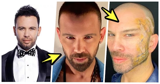 Şarkıcı Berksan, Yaptırdığı Fransız Askısı Operasyonundan Sonra Bambaşka Birine Dönüştü!