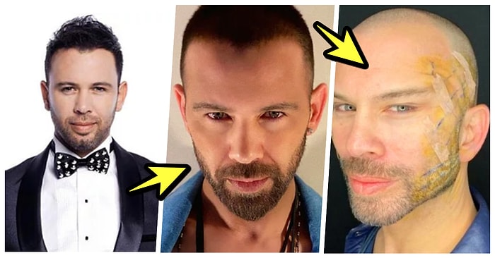 Şarkıcı Berksan, Yaptırdığı Fransız Askısı Operasyonundan Sonra Bambaşka Birine Dönüştü!