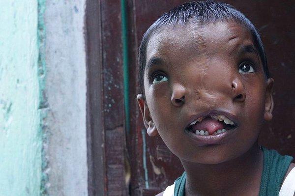 Hindistan'ın kuzeyindeki Uttar Pradeş kentinde Lakshmi isimli bir kız çocuğu, 2015 yılında 'fil burnuna' benzetilen bir burunla doğarak tüm ülkede ilgi odağı haline gelmişti.