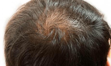 Saç Dökülmesi Sebepleri Nelerdir? Saç Dökülmesi Tedavisi…