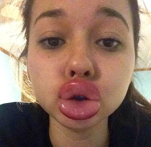 Ancak şu sıralar Kylie Jenner dudağı adlı yeni bir akım başladı. Sosyal medya kullanan pek çok genç dudaklarını bir pet şişe ile vakumlayarak, üst dudaklarını yapıştırıyor.