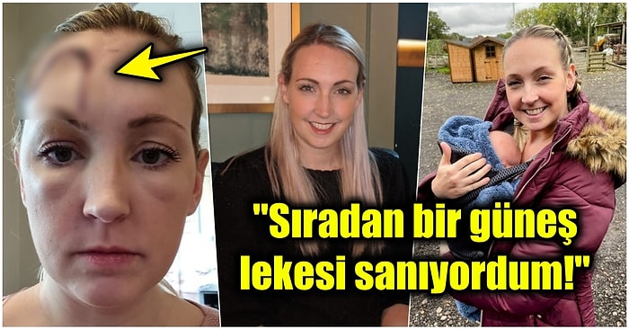 Bebeğinin Sağlığı İçin Yüzünde Günden Güne Büyüyen Tümörü Ameliyatla Aldırmayı Reddeden Anne