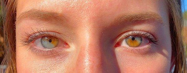 1. Kızın her iki gözünde de simetrik şekilde heterokromisi var...
