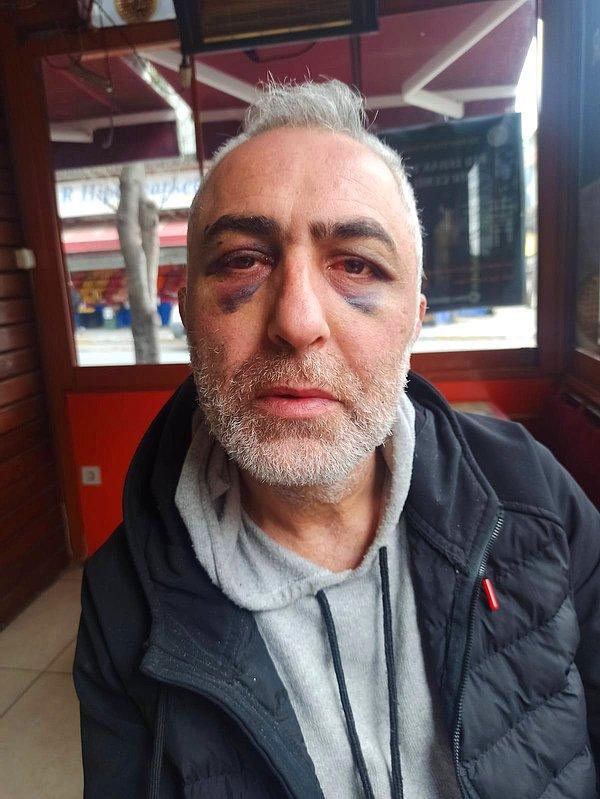 Polislerin darp ettiği Murat Kabak'ın kafasında kırıklar ve gözünde görme kaybı oluştuğu bildirilmişti.