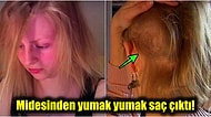 Kendi Saçını Yeme Bağımlılığı Olan Kadının Midesinden 'Kuyruklu' Dev Bir Tüy Yumağı Çıktı!