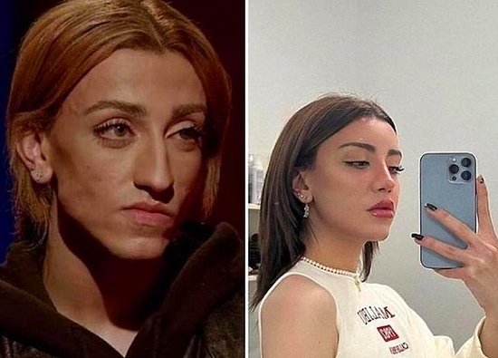 TikTok Fenomeni Mika Raun, Estetik Operasyonlarıyla Bambaşka Biri Oldu: İşte Sosyal Medyadan Gelen Tepkiler