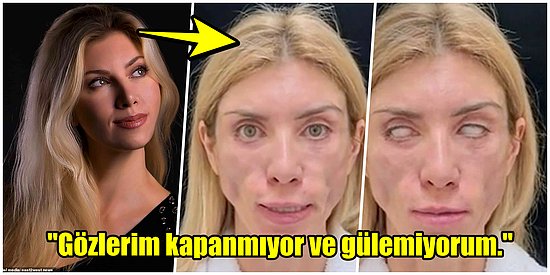 Güzelleşmek İsterken Tanınmaz Hale Gelen Rusya Eski Güzellik Kraliçesi Yulia Tarasevich'in Estetik Faciası