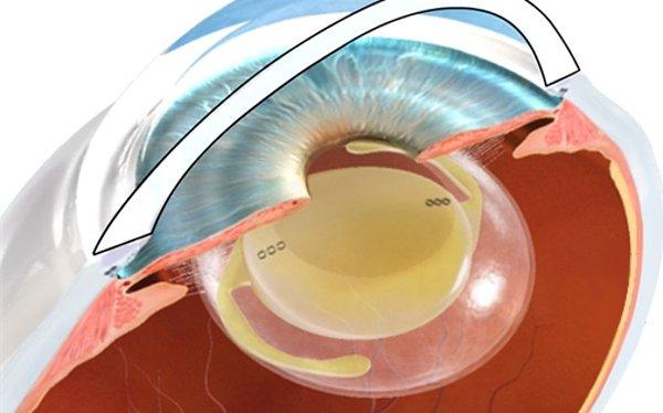 Göz İçi Lens Testi