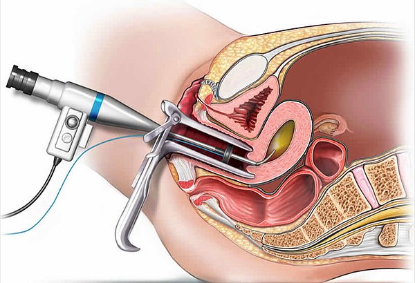 Histeroskopi Neden Yapılır?