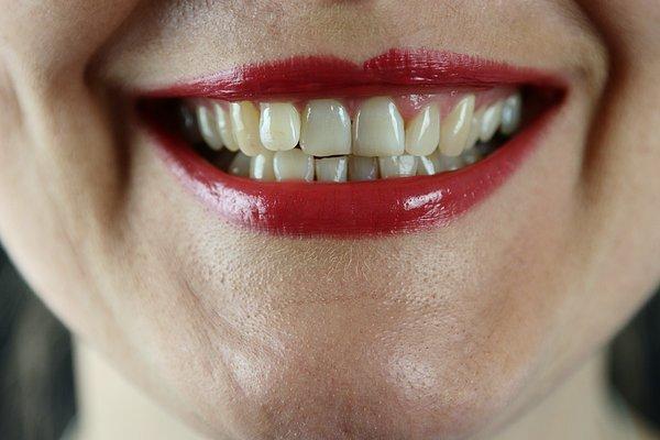 2. Annenin dişleri iyi olsa bile eğer babanın dişleri kötüyse, çocuğun da çarpık dişlere sahip olma ihtimali çok yüksek.
