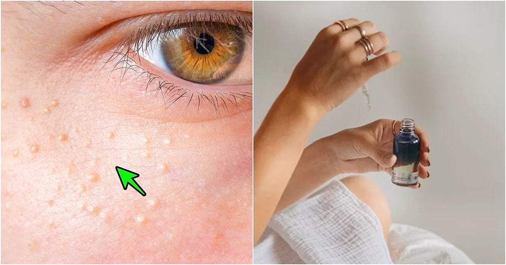 Yıllarca Cildimizde 'Sivilce Çıkmış' Diyerek Geçiştirdiğimiz Küçük Beyaz Noktaların Ne Olduğunu Açıklıyoruz!