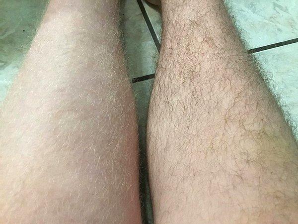 4. "Pigmentasyon yüzünden sağ bacak kıllarım siyahken sol bacağımdaki kıllar sarı."