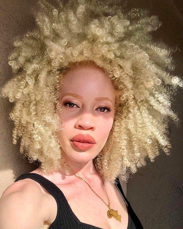 24. "Albinizm tamamen benim bir parçam ve benim çok hoşuma gidiyor."