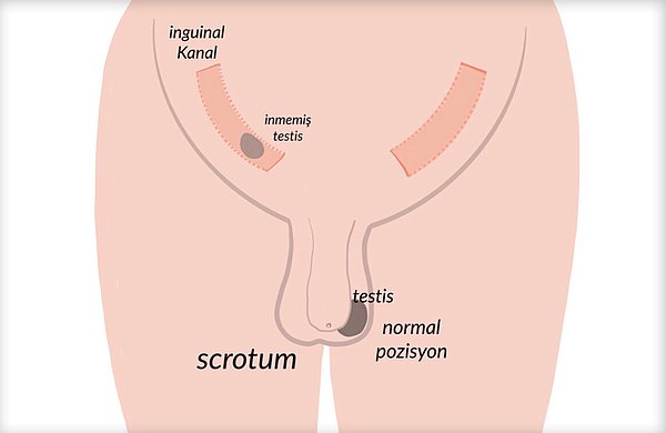 İnmemiş Testis Belirtileri Nelerdir?