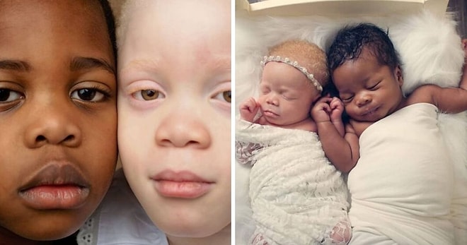 Женщина родила близнецов с разным цветом кожи, и подумала, что ей вручили не того ребенка