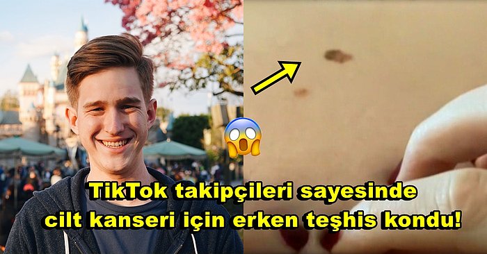 "TikTok Hayatımı Kurtardı!" : Takipçileri Sayesinde Kanserli Benini Fark Ederek Erken Tanı Konulan Fenomen