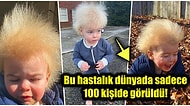 'Taranamayan Saç Sendromu' Adlı Oldukça Nadir Görülen Bir Rahatsızlığı Olan Dünya Tatlısı Çocuğun Hikayesi