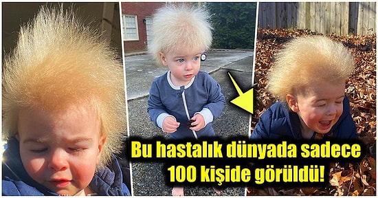 'Taranamayan Saç Sendromu' Adlı Oldukça Nadir Görülen Bir Rahatsızlığı Olan Dünya Tatlısı Çocuğun Hikayesi