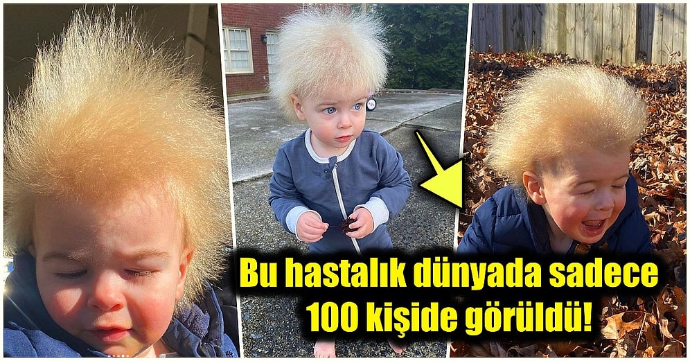 'Taranamayan Saç Sendromu' Adlı Oldukça Nadir Görülen Bir Rahatsızlığı Olan Dünya Tatlısı Çocuğun Hikayesi