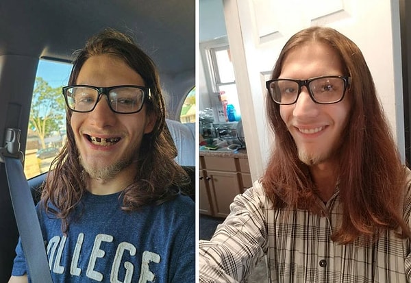 7. После долгих лет зубной боли и сокрытия улыбки я получил зубные протезы! Они буквально заставили меня улыбнуться