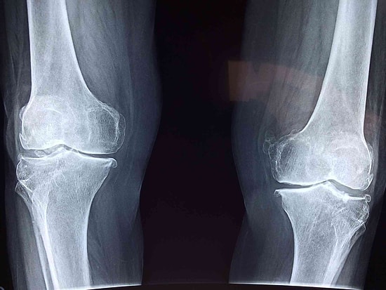 Kemik İltihabı (Osteomyelit) Nedir? Kemik İltihabı Belirtileri ve Tedavisi…