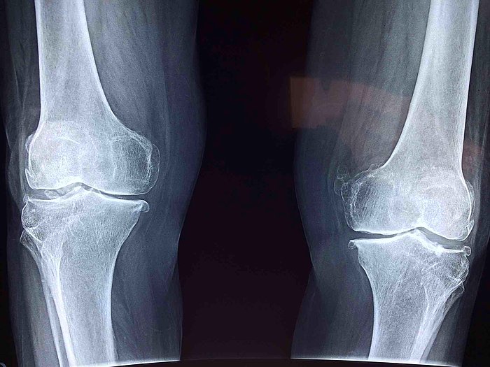 Kemik İltihabı (Osteomyelit) Nedir? Kemik İltihabı Belirtileri ve Tedavisi…