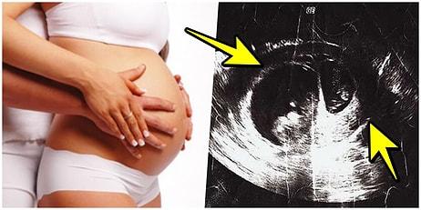 Hamileyken Tekrar Hamile Kalınabilir mi?