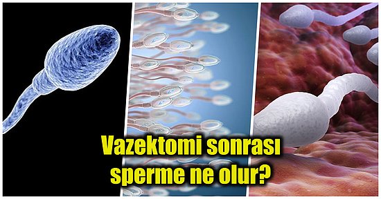 Sperm Kanalları Kapatılarak Gerçekleşen Vazektomiden Sonra Vücutta Kalan Spermlere Ne Olur?