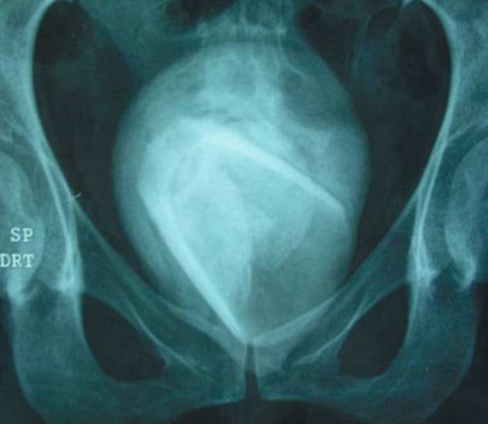 45-летней женщине их Туниса удалили из мочевого пузыря стеклянный стакан спустя четыре года после того, как она использовала его в «эротических целях»