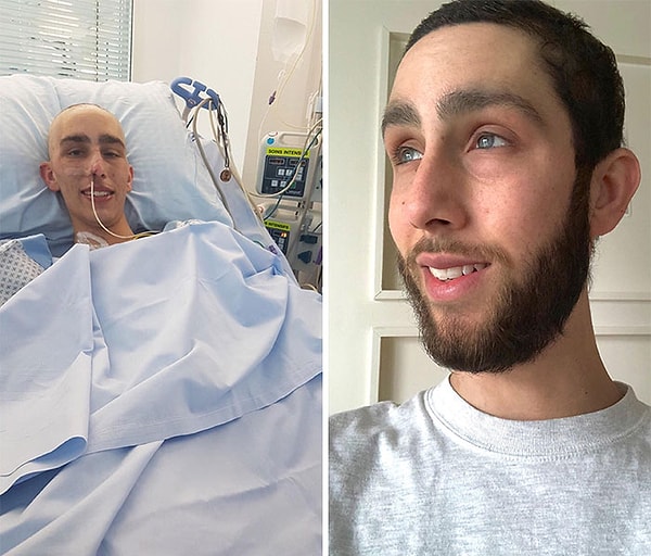 3. Прошел химиотерапию, решил победить рак и впервые попробовать отрастить бороду. Никогда не оглядывался назад