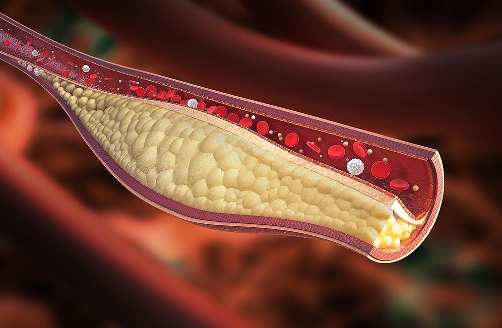 Kolesterol Belirtileri Nelerdir? Kolesterol Nasıl Düşürülür?