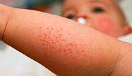 Çocuklarda Atopik Dermatit Belirtileri Tedavisi…