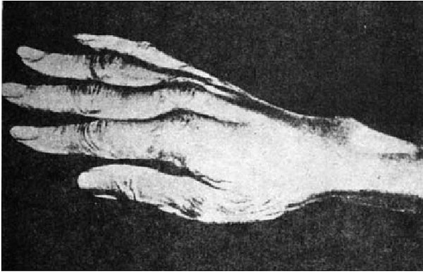 Parmakları normalden çok daha uzun ve esnek olan Paganini, yeteneğinin yanı sıra bu sendromdan dolayı ellerinde oluşan değişim yüzünden de 'şeytanın oğlu' gibi isimler aldı.