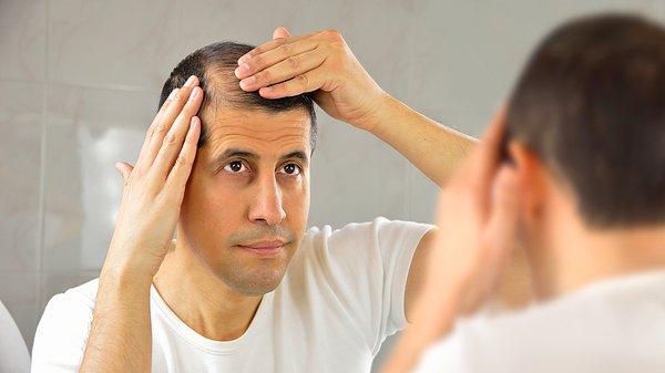 Erkek tipi saç dökülmesine de androgenetik alopesi deniyor ve toplumda daha normal karşılanıyor.