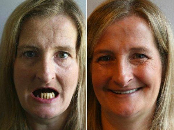 11. Dişleriyle beraber tüm çene yapısı değiştirilen kadının sevindiren değişimi;