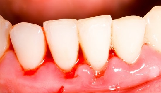 Diş Eti Kanaması Nedir? Diş Eti Kanaması Neden Olur, Nasıl Geçer?