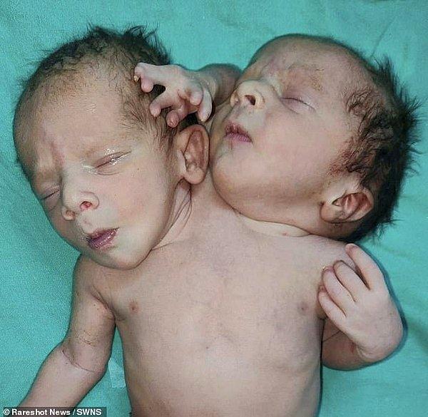 Hindistan'da iki kafalı, üç kollu ve iki kalpli doğan bebek, doktorları şoka uğrattı.
